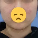 バッカルファット除去 / 脂肪吸引（顔） 湘南美容クリニック 秋葉原院 BEFORE サムネイル用