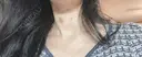 マイクロボトックス / ボトックス（眉間） / ボトックス（目尻） / ボトックス（額） DMTC美容皮膚科 大宮院 BEFORE サムネイル用