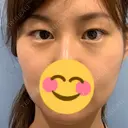 ボトックス（目尻） TCB東京中央美容外科 梅田茶屋町院 BEFORE サムネイル用