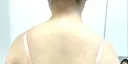 ボトックス（エラ・小顔） / ボトックス（口角） / ボトックス（肩） M'sクリニック【エムズクリニック】 BEFORE サムネイル用