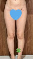 脂肪吸引（顔） / 脂肪吸引（脚） / 脂肪吸引（お尻） Mods Clinic（モッズクリニック） 福岡院 BEFORE サムネイル用