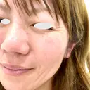 脂肪溶解注射（顔） / ヒアルロン酸注入（頬） / ボトックス（眉間） / ボトックス（目尻） / ハイフ（顔） TCB東京中央美容外科 立川院 BEFORE サムネイル用