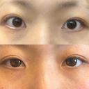 目頭切開 LUHO（ルホ）美容外科 BEFORE サムネイル用