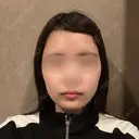 骨切り（あご） / 骨削り（エラ） / 骨削り（頬） / バッカルファット除去 / 脂肪吸引（顔） バタン美容整形外科 BEFORE サムネイル用