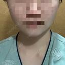 脂肪吸引（顔） / あご下筋肉縛り セギム美容整形外科 BEFORE サムネイル用