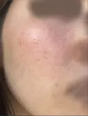 ヴァンパイアフェイシャル 大阪TAクリニック BEFORE サムネイル用