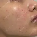 ポテンツァ ARTE BEAUTY CLINIC BEFORE サムネイル用