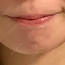 ボトックス（あご） ルラ美容クリニック 池袋院 BEFORE サムネイル用