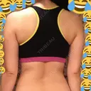 脂肪吸引（二の腕） / 脂肪溶解注射（二の腕） THE SKINNY CLINIC（ザ・スキニークリニック） BEFORE サムネイル用