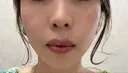 ボトックス（エラ・小顔） / ボトックス（口角） ブルームクリニック（BLOOM CLINIC） BEFORE サムネイル用