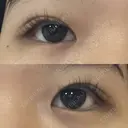 ヒアルロン酸注入（涙袋） ファイヤークリニック 渋谷院 BEFORE サムネイル用