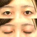二重埋没 ルラ美容クリニック 渋谷本院 BEFORE サムネイル用