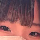 二重埋没 / 目頭切開 城本クリニック 長崎院 BEFORE サムネイル用