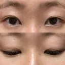 二重切開 表参道スキンクリニック 表参道院 BEFORE サムネイル用