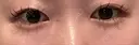 二重切開 Olino美容外科・美容皮膚科 BEFORE サムネイル用