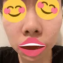 鼻尖形成（切開） / 鼻中隔延長（切開） / 小鼻縮小（切開） / バッカルファット除去 / 脂肪吸引（顔） / 軟骨移植 / 眉間プロテーゼ / 鼻尖縮小 ジョウクリニック 大阪院 BEFORE サムネイル用