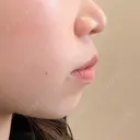 ヒアルロン酸注入（あご） 東京エビスクリニック BEFORE サムネイル用