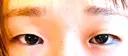 目頭切開 / 自然癒着法 / 眼瞼下垂（非切開） LUHO（ルホ）美容外科 BEFORE サムネイル用