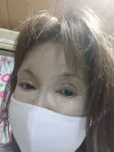 リジュラン 湘南美容クリニック 所沢院 BEFORE サムネイル用