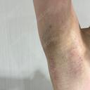 ワキ汗治療（レーザー） Fellez Clinic【フェルズクリニック】 BEFORE サムネイル用