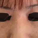 美肌レーザー / ピコレーザートーニング（美白・肝斑） CLINIC W BEFORE サムネイル用
