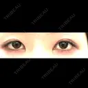 目頭切開 アリエル美容クリニック 郡山院 BEFORE サムネイル用