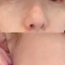 ルビーレーザー S-Laboクリニック 渋谷院 BEFORE サムネイル用