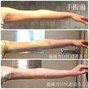 脂肪吸引（二の腕） ヨンセスリムライン BEFORE サムネイル用