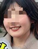 糸リフト / 脂肪吸引（顔） / あご下筋肉縛り / 脂肪注入（輪郭） セギム美容整形外科 BEFORE サムネイル用