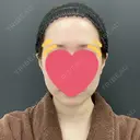 脂肪吸引（顔） BLINC CLINIC （ブリンク クリニック） BEFORE サムネイル用