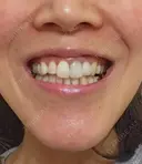 セラミック / その他（審美歯科/矯正歯科） 東京美容外科 赤坂院 BEFORE サムネイル用