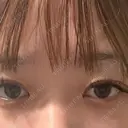 二重埋没 / 目頭切開 / 糸リフト / 脂肪吸引（顔） / ヒアルロン酸注入（涙袋） R Beauty CLINIC 名古屋院 BEFORE サムネイル用