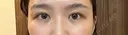 ボトックス（目尻） スキンリファインクリニック銀座 BEFORE サムネイル用