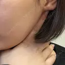 白玉点滴・注射 APOLLO BEAUTY CLINIC BEFORE サムネイル用