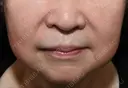 糸リフト / ヒアルロン酸注入（首） 藤・ナチュレ美容クリニック 銀座院 BEFORE サムネイル用