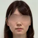 糸リフト / 脂肪吸引（顔） / ジョールファット除去 / 脂肪吸引注射（顔） / ヒアルロン酸注入（あご） SEA CLINIC（シークリニック） BEFORE サムネイル用