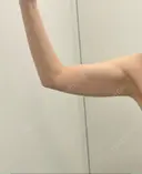 脂肪吸引（二の腕） イテウォンビューティークリニック 名古屋栄院 BEFORE サムネイル用