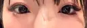 ヒアルロン酸注入（涙袋） ファイヤークリニック 新宿院 BEFORE サムネイル用