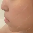 ヒアルロン酸注入（唇） / ボトックス（口角） / ヒアルロン酸注入（頬） / イオン導入 / ルメッカ ルラ美容クリニック 大宮院 / ルラスキンクリニック 大宮院 BEFORE サムネイル用