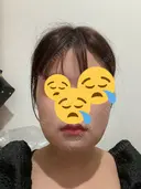 脂肪吸引（顔） / ボトックス（エラ・小顔） ネビュラクリニック 京都院 BEFORE サムネイル用