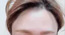 脂肪注入（肌） / 再生医療 / PRP皮膚再生療法 iSTAR美容外科・皮膚科 BEFORE サムネイル用