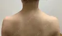 ボトックス（肩） / ボトックス（眉間） / ボトックス（額） ルラ美容クリニック 大阪本院 BEFORE サムネイル用