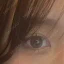 ヒアルロン酸注入（涙袋） ファイヤークリニック 銀座院 BEFORE サムネイル用