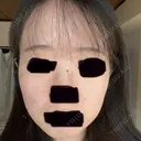 エレクトロポレーション / ピーリング（ハリ・ツヤ） LIFIX BEAUTY CLINIC BEFORE サムネイル用