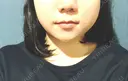 脂肪吸引（顔） / ボトックス（エラ・小顔） ネビュラクリニック 京都院 BEFORE サムネイル用