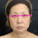 二重埋没 / 糸リフト / クマ治療 / ヒアルロン酸注入（あご） / ボトックス（肩） / ボトックス（眉間） / ボトックス（首） / ヒアルロン酸注入（首） 藤・ナチュレ美容クリニック 銀座院 BEFORE サムネイル用