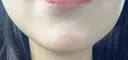 ボトックス（あご） ルラ美容クリニック 名古屋本院 BEFORE サムネイル用