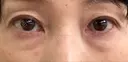 下まぶたの脂肪取り / 脂肪注入（肌） / 脂肪注入（目の下） X CLINIC 大阪院 BEFORE サムネイル用