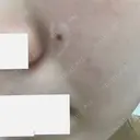 ほくろ・いぼ除去レーザー（肌） フェアクリニック川口 BEFORE サムネイル用