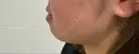 糸リフト / 脂肪吸引（顔） / ヒアルロン酸注入（あご） / ボトックス（エラ・小顔） R Beauty CLINIC 名古屋院 BEFORE サムネイル用
